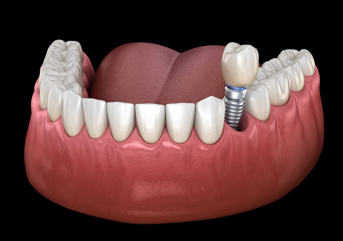 Dental Implant Surgery in Greenville SC Area