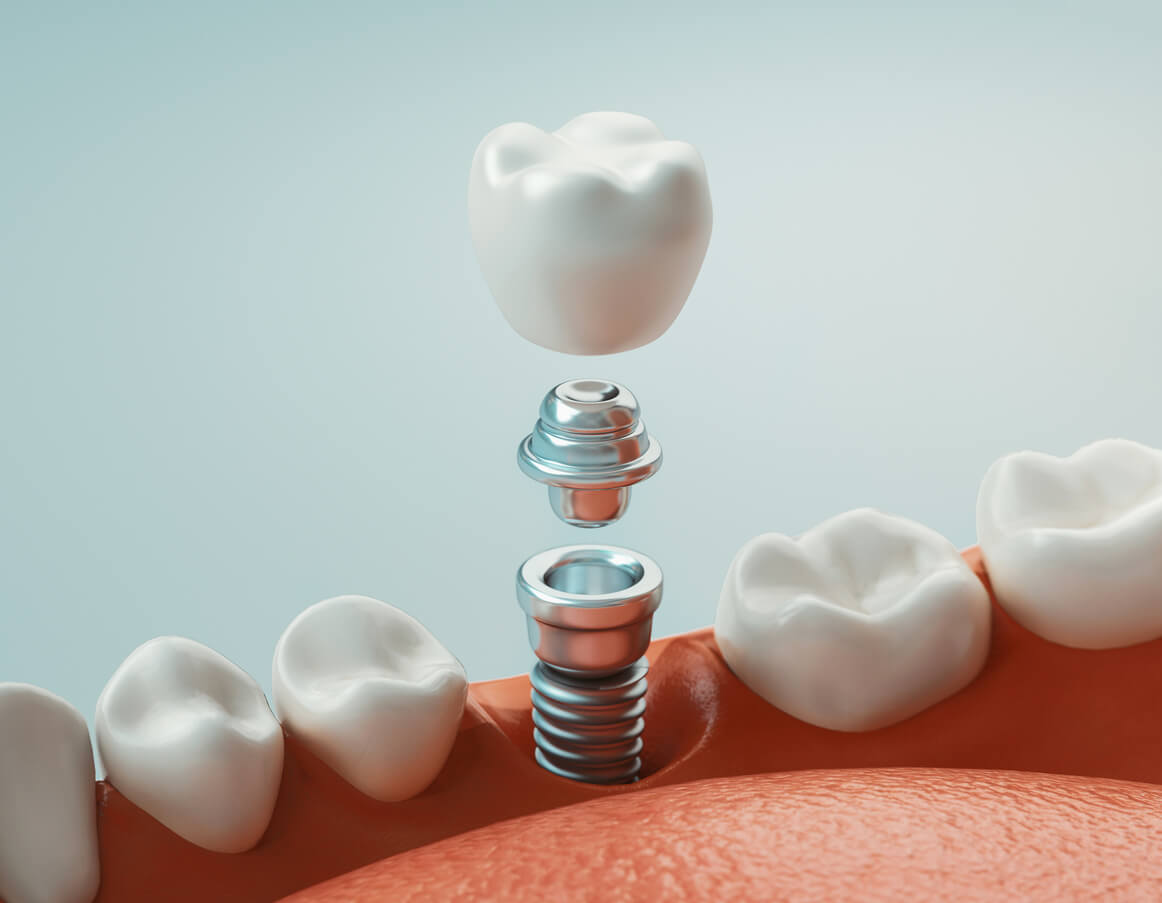 How Painful Are Teeth Implants?