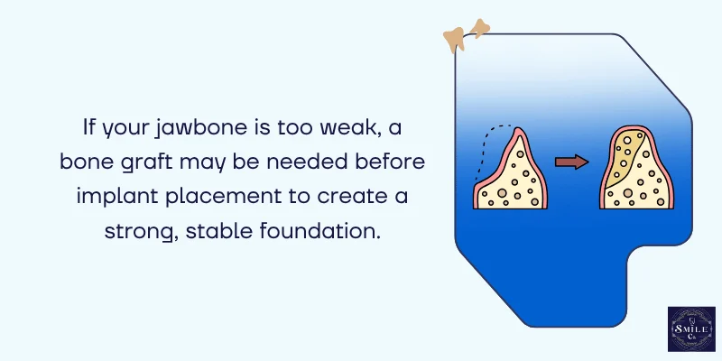 Bone Grafting Considerations