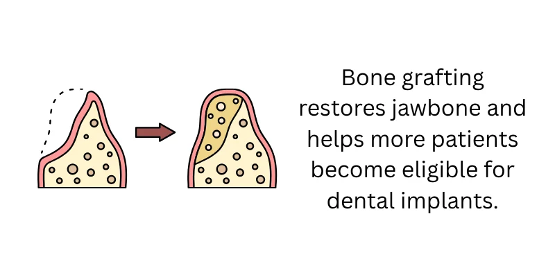 Bone Grafting The Foundation for Dental Implants