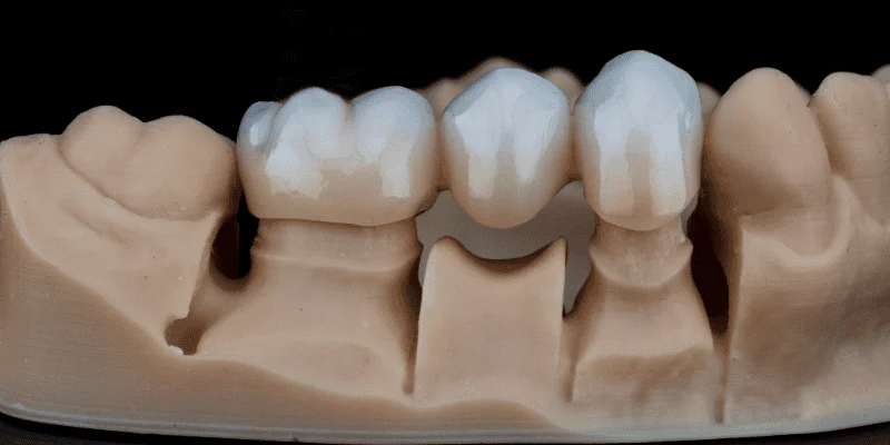 Dental Crowns and Bridges