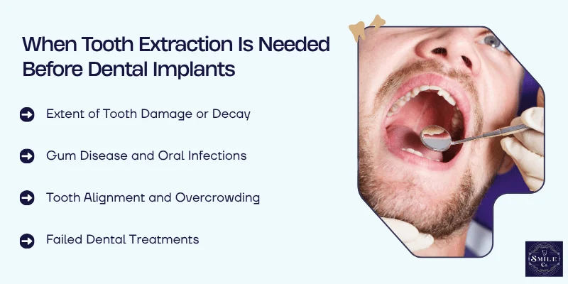 Key Factors That Influence Tooth Extraction Before Implants
