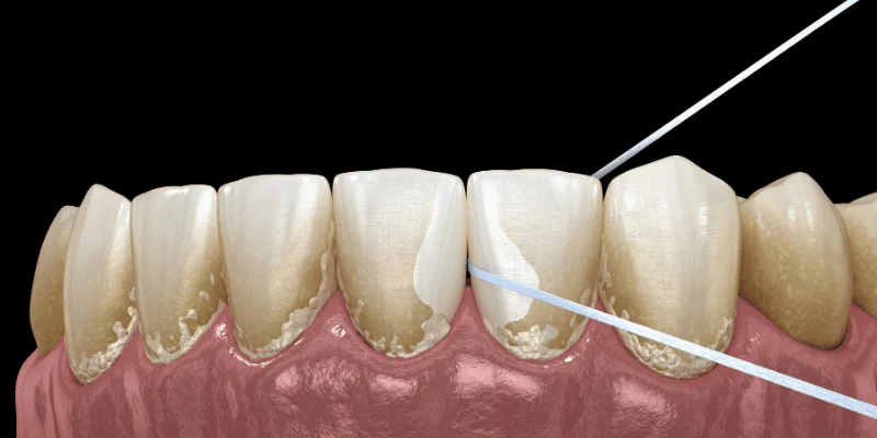 Plaque Accumulation and Peri-Implant Tissues