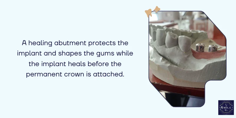 What Is a Healing Abutment
