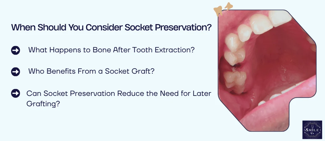 When Socket Preservation Is Worth Considering