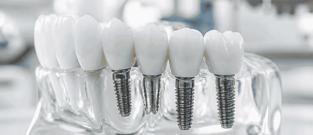 how to clean dental implants 1