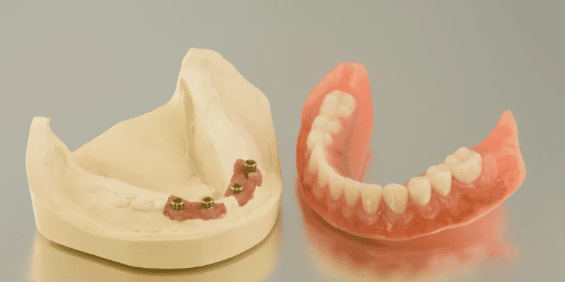 implant dentures vs regular dentures