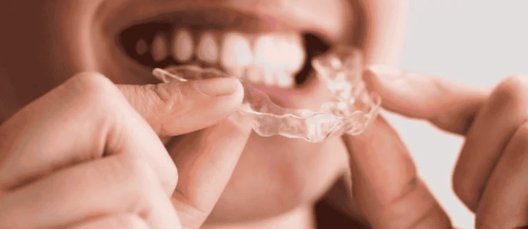 night guard for dental implants