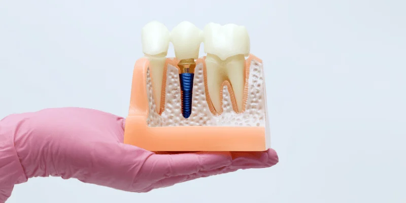 stages of dental implant treatment