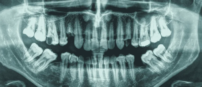 types of dental bone grafts