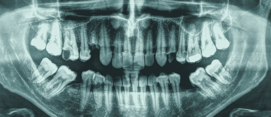 types of dental bone grafts